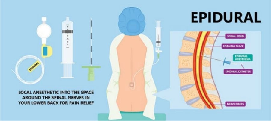 epidural-kit-4